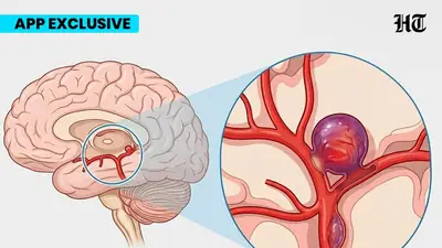 brain aneurysm app 1775549794056 1775549812919